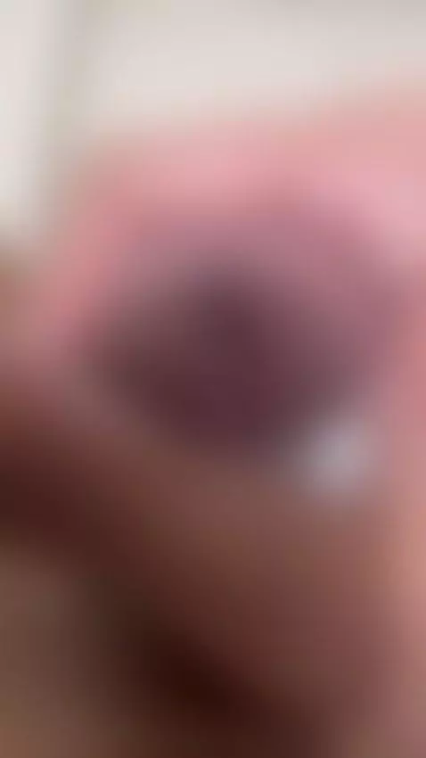 onlay by valirya-devote